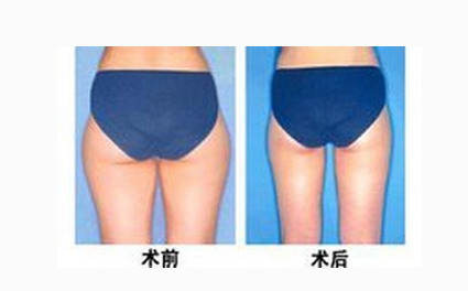 臀部吸脂術(shù)有什么副作用嗎