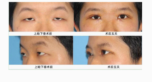 上眼臉下垂手術有哪些副作用