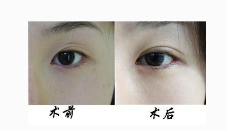 雙眼皮失敗修復(fù)手術(shù)多少錢