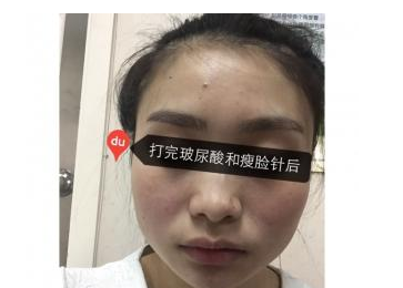 玻尿酸面部填充+瘦臉針 讓我的面貌更加精致美麗 - 珍美網(wǎng)