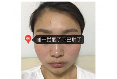 玻尿酸面部填充+瘦臉針 讓我的面貌更加精致美麗 - 珍美網(wǎng)
