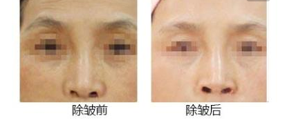 激光緊膚除皺效果怎么樣