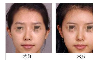 自體脂肪豐額部效果怎么樣