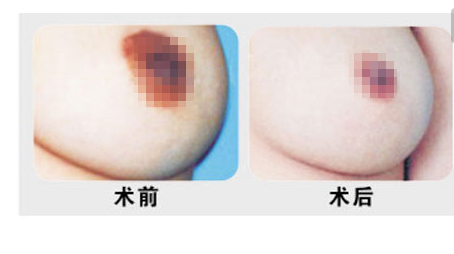 乳頭縮小術(shù)效果怎么樣