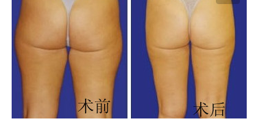 臀部吸脂手術(shù)效果好不好