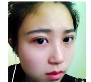 割雙眼皮手術(shù)  大眼睛真的好迷人啊