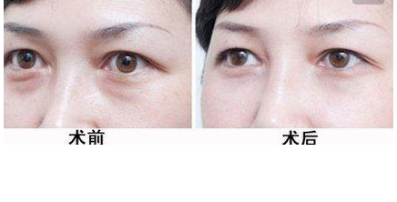 激光祛黑眼圈的好處有哪些