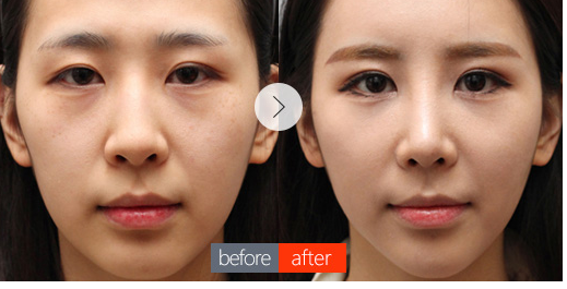 玻尿酸豐臥蠶手術(shù)多少錢