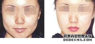 磨顴骨整形多少錢