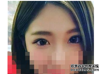埋線雙眼皮手術(shù)   明亮美麗的大眼美眉