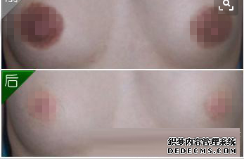 乳暈縮小術需要多少錢