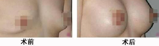 乳房再造手術(shù)有沒有危害呢