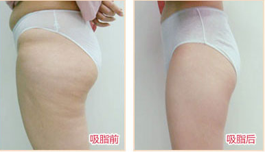 臀部吸脂手術(shù)多少錢