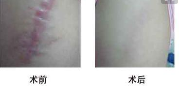 光子嫩膚去疤效果好不好