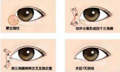 雙眼皮、開眼角術(shù)后恢復(fù)時間和注意事項