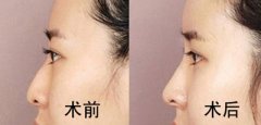 假體隆鼻需要多少錢？