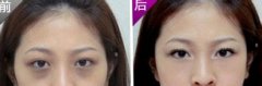 激光去黑眼圈不會有什么傷害嗎