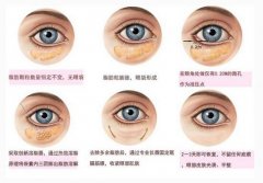 北京哪里有好的去眼袋專家？