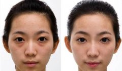 成都去眼袋有著什么樣的好方法？