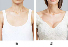 長沙隆胸自體脂肪需要多少錢？脂肪隆胸價格詳解