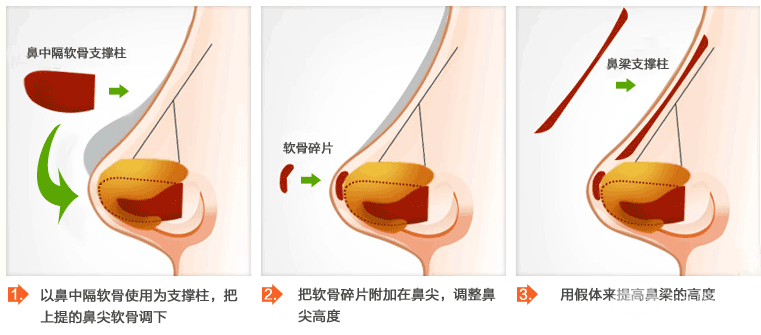 成都玉之光雙眼皮、隆鼻多少錢？