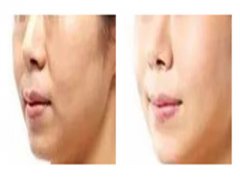 玻尿酸和水光針有什么不一樣？