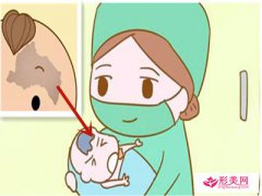 胎記怎么去除_激光去胎記后多久恢復(fù)