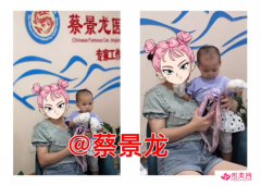 四川一歲寶寶燙傷畸形的小手終于張開