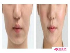 打瘦臉針的副作用_瘦臉針有沒(méi)有副作用