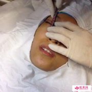 倒睫雙眼皮術(shù)式手術(shù)后護理注意事項
