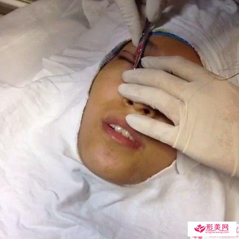 倒睫雙眼皮術(shù)式手術(shù)后護理注意事項