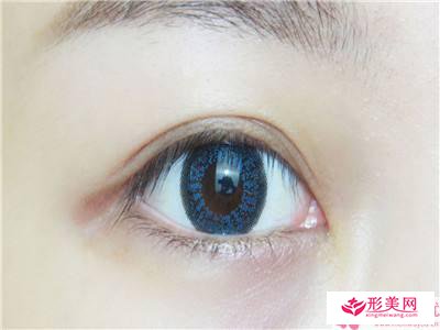 芭比無痕雙眼皮成型術式效果安全嗎