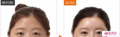 芭比無痕雙眼皮成型術(shù)式效果安全嗎？