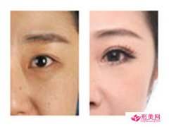 眼部除皺的方法_眼部除皺哪種方法比較好？