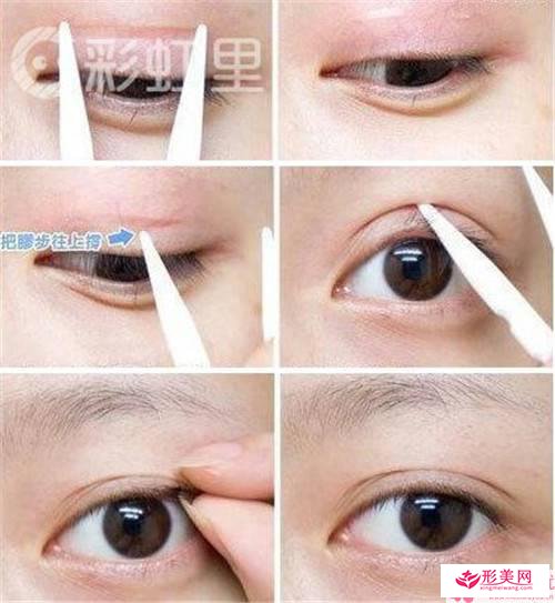 3點(diǎn)切開雙眼皮后的護(hù)理注意事項(xiàng)有哪些
