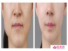 改變臉型的方法_改臉型一般有哪些項目