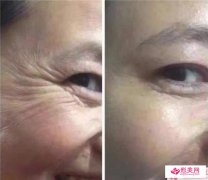 除掉痤瘡的方法有哪些？