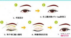 三點定位雙眼皮多久恢復(fù)？護(hù)理能縮短恢復(fù)時間嗎？