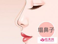 假體隆鼻常見的材料?
