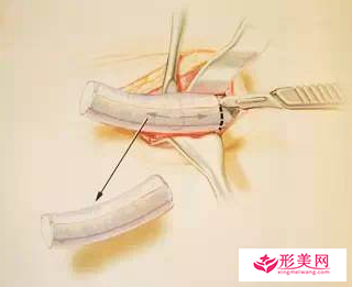 做自體軟骨隆鼻后多久能正常上班