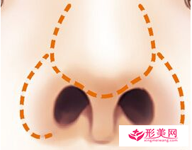 鼻翼縮小手術潛在的后遺癥風險