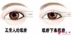 眼瞼下垂能做雙眼皮手術(shù)嗎？