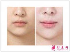 人中縮短術(shù)_人中縮短術(shù)前注意事項(xiàng)？