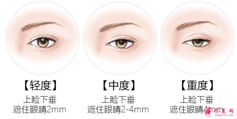 上眼皮下垂有什么方法改善嗎