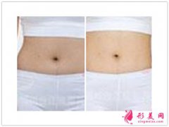 吸脂手術(shù)_吸脂手術(shù)有什么危害？