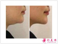 雙下巴吸脂術(shù)_雙下巴吸脂后注意事項？