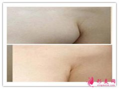 副乳注意事項(xiàng)-做了副乳應(yīng)該注意什么呢