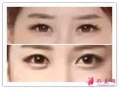 玻尿酸豐臥蠶注意事項_玻尿酸豐臥蠶哪些不適合？