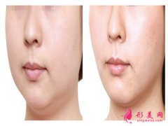 面部吸脂_面部吸脂瘦臉要多久恢復(fù)？
