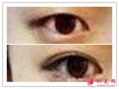 上瞼下垂矯正護(hù)理_上瞼下垂矯正術(shù)后怎樣護(hù)理？